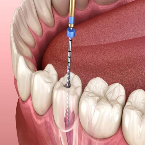 ENDODONZIA